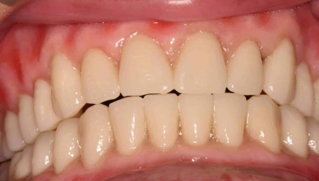 prothese amovible e1674659023143